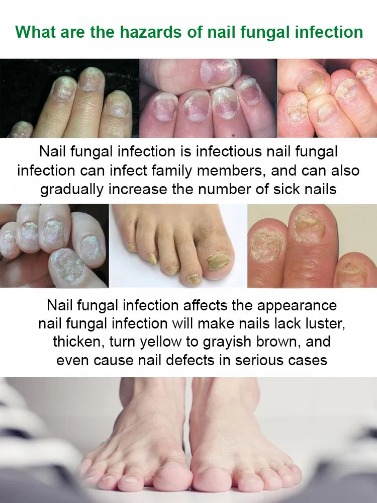 Tea Tree & Ginger Nail Fungus Care Serum – Advanced Nail Repair Formula