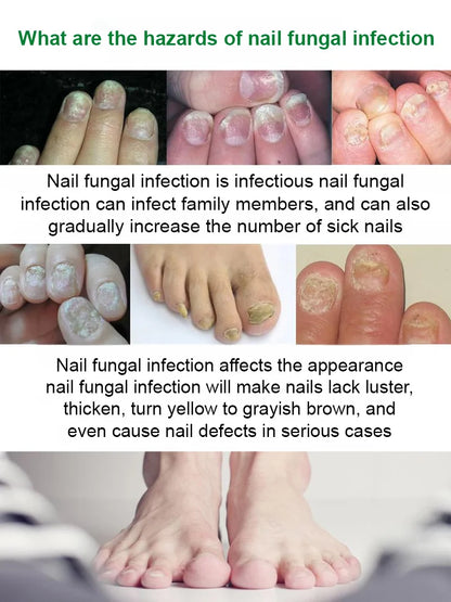 Tea Tree & Ginger Nail Fungus Care Serum – Advanced Nail Repair Formula