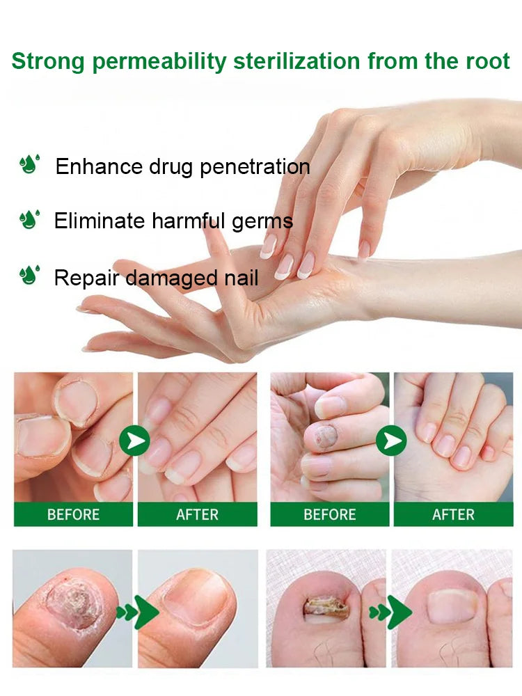 Tea Tree & Ginger Nail Fungus Care Serum – Advanced Nail Repair Formula